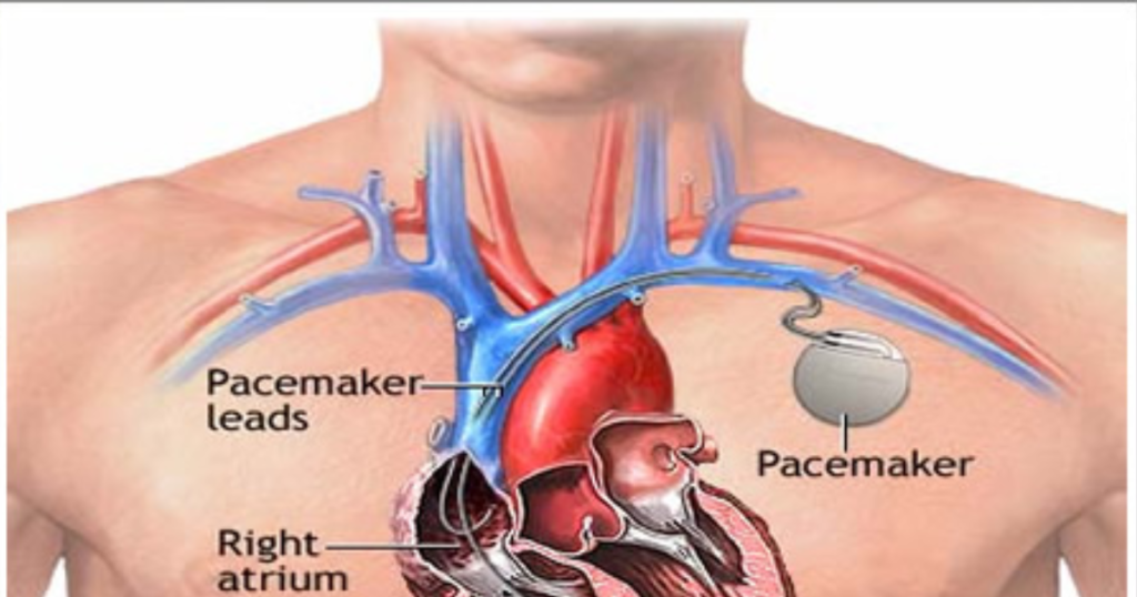 Types of Pacemaker - Cardiac Surgeon in Indore