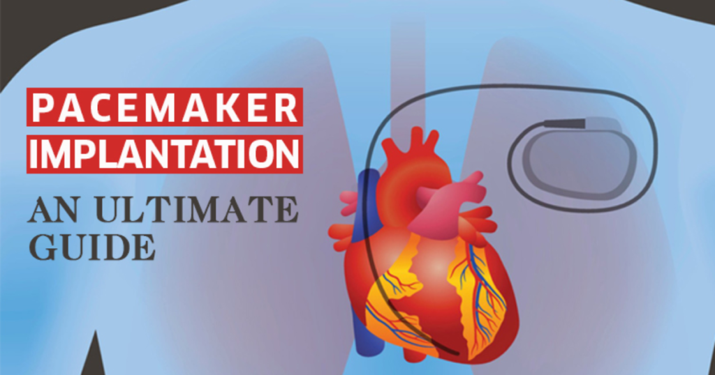 What is Pacemaker - Cardiac Surgeon in Indore