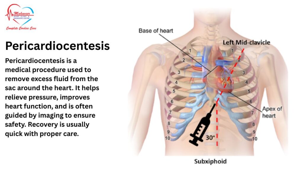 Pericardiocentesis - Dr Rakesh jain - Best cardiologist