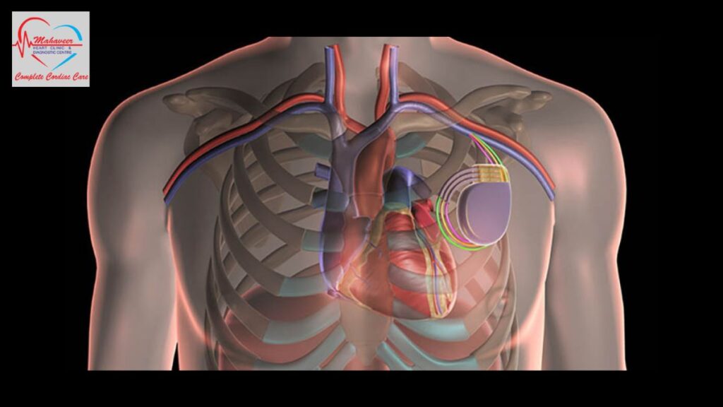 cardiac-resynchronization-therapy by Dr Rakesh Jain - Top cardiologist In Indore