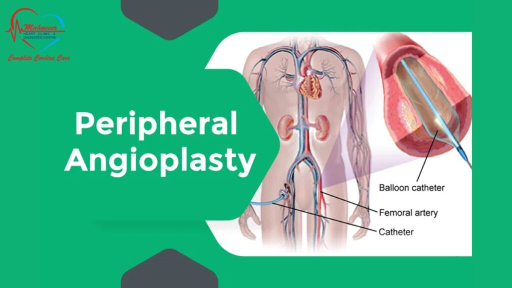 peripheral-angioplasty - Dr Rakesh Jain - Best Cardiologist